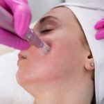 Microneedling