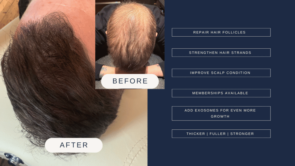 Hair restoration and regrowth treatment perfect for those wanting a hair transplants.